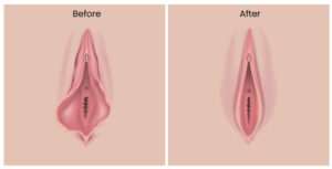 Before and After Photos of Labiaplasty Surgery in Brooklyn, Manhasset, Manhattan, NY, Greenwich, CT, Ridgefield, NJ