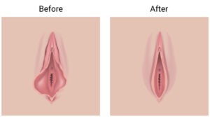 Before and after surgery diagram for Labiaplasty in Manhattan, Brooklyn, Manhasset, NYC, Greenwich, CT, Ridgefield, NJ